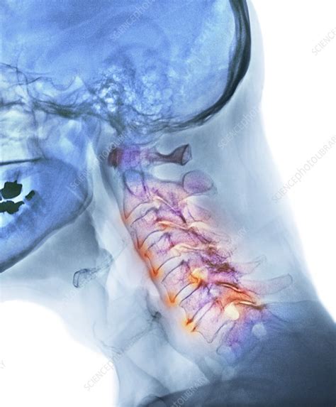 Arthritis Of The Neck X Ray Stock Image F0033625 Science Photo