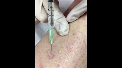 Sclerotherapy Procedure Youtube