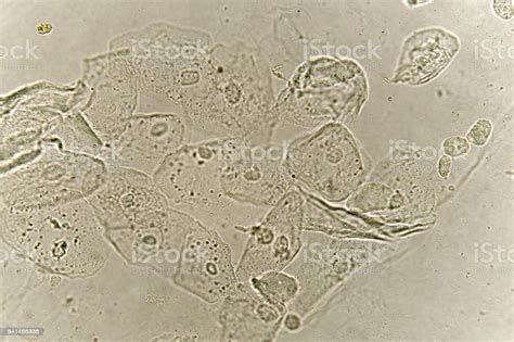 What is epithelial cells in urine. Epithelial Cells With Bacteria In Patient Urine Stock ...