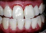 Sore Gums And Teeth On One Side Photos