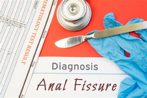 Anal Fissures Its Causes Symptoms And Management Faqbulletin Com