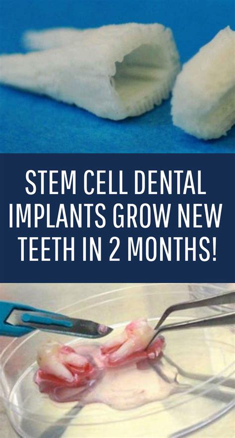 Stem Cell Dental Implants Grow New Teeth In 2 Months Dental Implants
