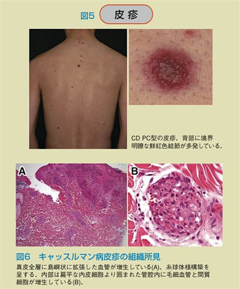 キャッスルマン病（castleman Disease；cd）｜plus Chugai 中外製薬医療関係者向けサイト（医師向け）