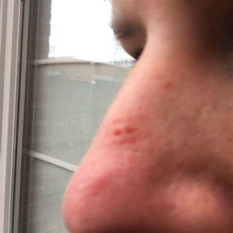 Punch Biopsy On Nose Hot Sex Picture