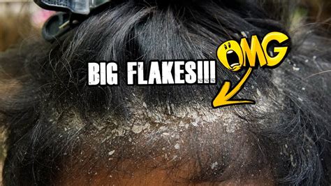 Big Flakes Of Dandruff On Scalp Dandruff Scratching With Black Comb