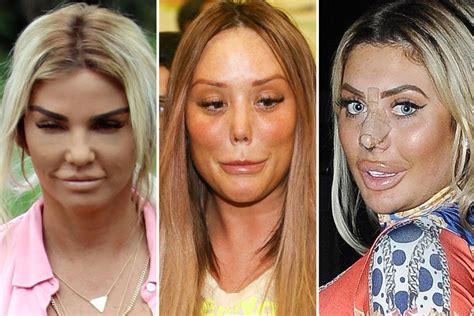 From Katie Price To Chloe Ferry These Are The Biggest Celebrity Plastic Surgery Disasters Ever