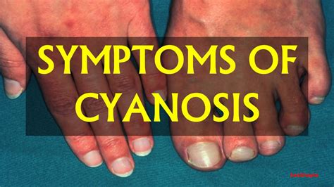 Symptoms Of Cyanosis Youtube