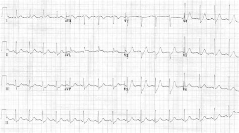 Anterior Myocardial Infarction Litfl Ecg Library