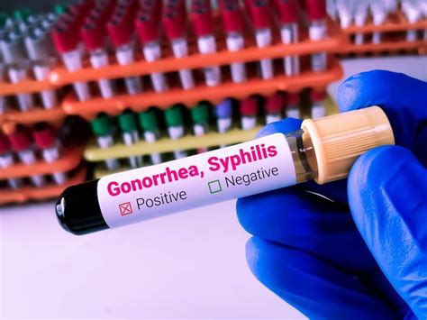 Sifilizi Simptomat Shkaqet Diagnoza Trajtimi