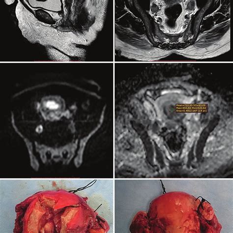 PDF Role Of Diffusion Weighted Magnetic Resonance Imaging In The Characterization Of Uterine