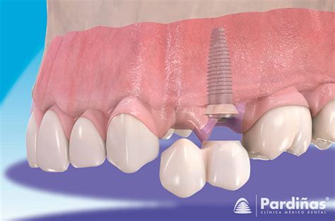 El puente dental Tipos partes y colocación del puente Clínica Pardiñas