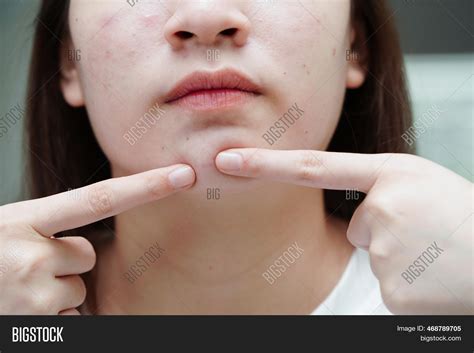 Acne Pimple Scar On Image And Photo Free Trial Bigstock