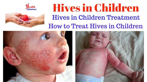 Hives In Children Hives In Children Treatment How To Treat Hives In