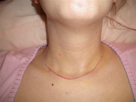 My Thyroidectomy Experience The Gluten Free Blogger Thyroidectomy
