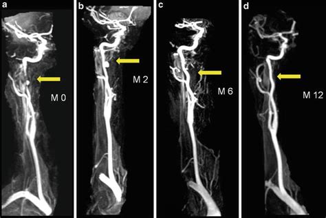 Internal Carotid Artery Mri