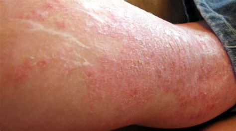 Zinc Oxide Atopic Dermatitis Atopic Dermatitis Symptoms