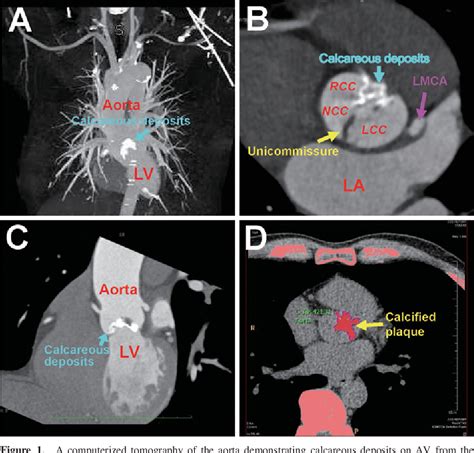 Figure 1 From Assessment Of Unicuspid Aortic Valve Stenosis Using