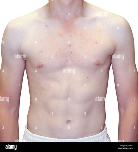 Teenage Boy Acne Hi Res Stock Photography And Images Alamy