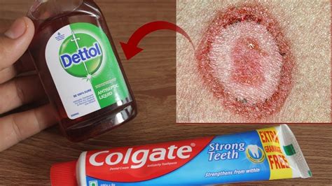 How To Get Rid Of Ringworm Fast At Home In Just Overnight How To