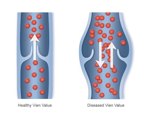 Chicago Vein Care Center Implications Of Diseases Of Veins In Chicago