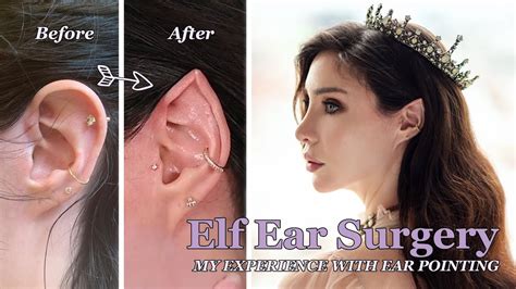 I Got Elf Ear Surgery My Experience With Ear Pointing Youtube