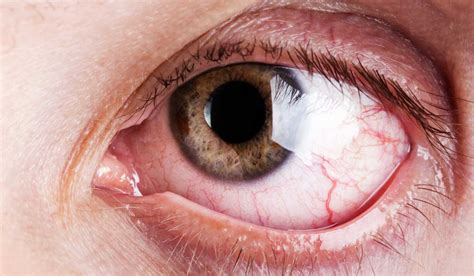 síndrome del ojo seco cada vez más común