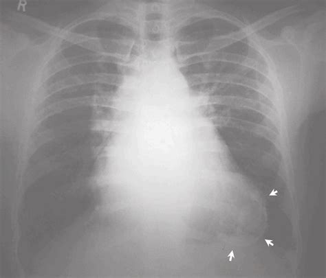 Chest X Ray Pa View Showing Calcific Left Ventricular Aneurysm Arrows