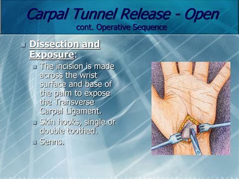 Ppt Carpal Tunnel Release Open Powerpoint Presentation Free