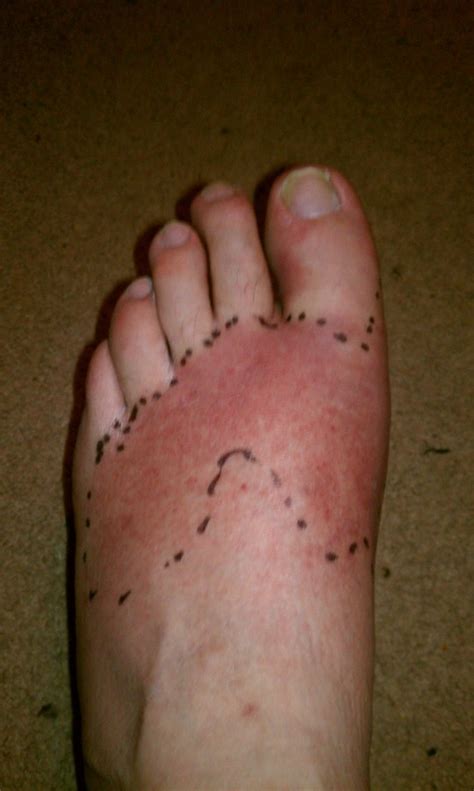 Discover More Than 133 Antibiotic For Nail In Foot Super Hot Noithatsivn
