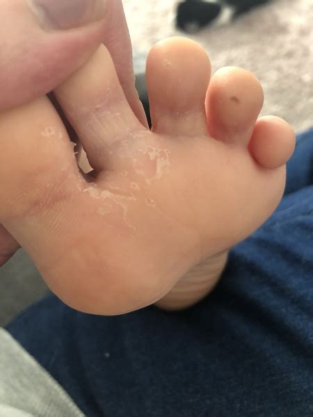 Ingredients 200g plain flour 100g butter cubed 1 tbsp icing sugar 1 egg beaten 1kg apples (cooking and eating mixture) recipe by mumsnet. What's this on DS's feet? Athletes foot? | Mumsnet