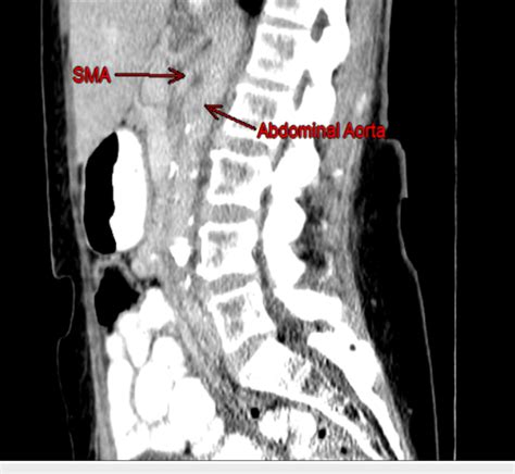 Sma And The Abdominal Aorta Sagittal Ct Scan Image Is Identical To