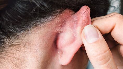 Rash Behind Ear Try Homeopathy Unfoldingmatrix