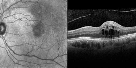 Branch Retinal Vein Occlusion Brvo Northern Sydney Cataract