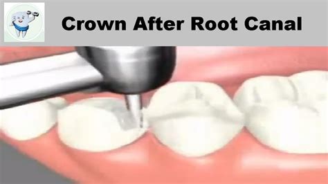 Dental Crown Procedure After Root Canal Youtube