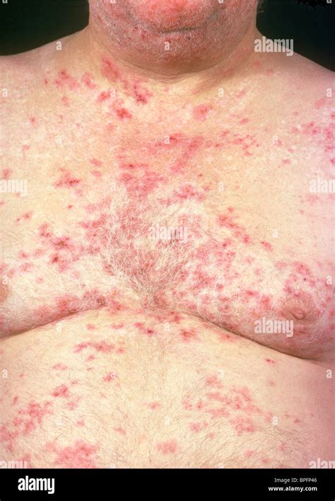 Dermatitis Herpetiforme Fotografías E Imágenes De Alta Resolución Alamy