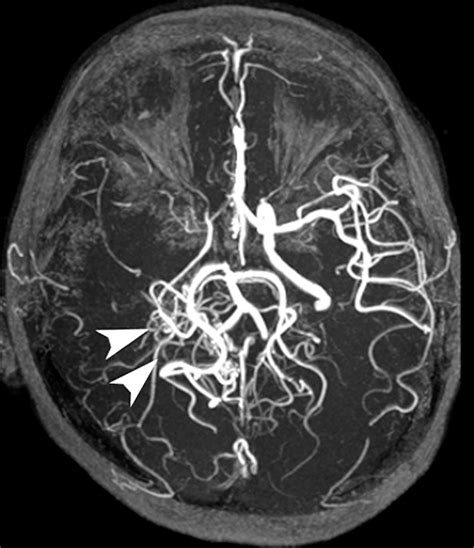 Imaging Collateral Circulation Magnetic Resonance Angiography And