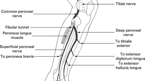 Superficial Peroneal Nerve Injury Injury Choices