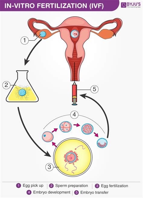 In Vitro Fertilisation Diagram And Procedure