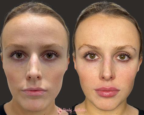 Lip Filler Before After Results Skinly Aesthetics