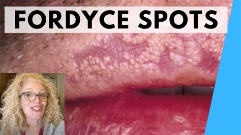 Syringoma Vs Fordyce Spots Natural Remedies Youtube