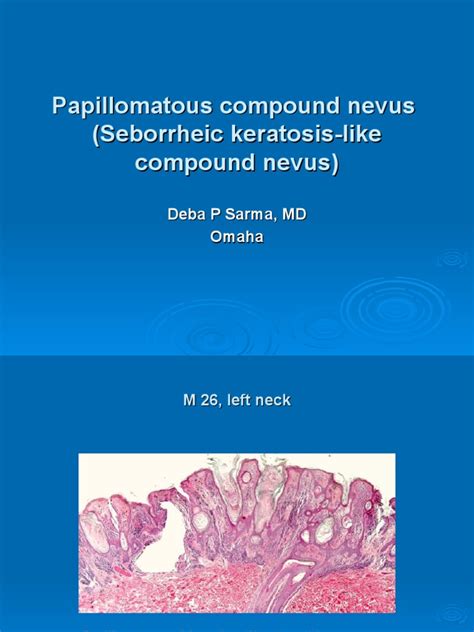 Papillomatous Compound Nevus Seborrheic Keratosis Like Compound Nevus