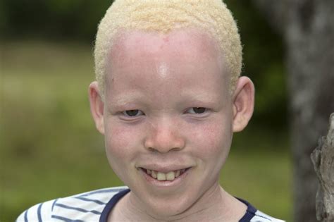 Albinism Achromia Achromasia Achromatosis Cypress Eye Centre
