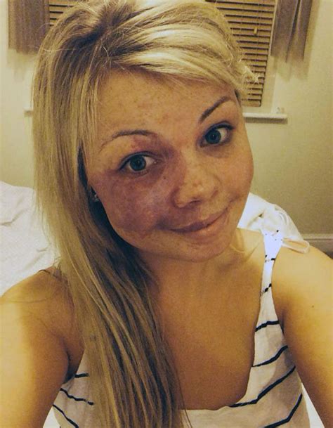 No Make Up Selfie Woman Reveals Birthmark Daily Star