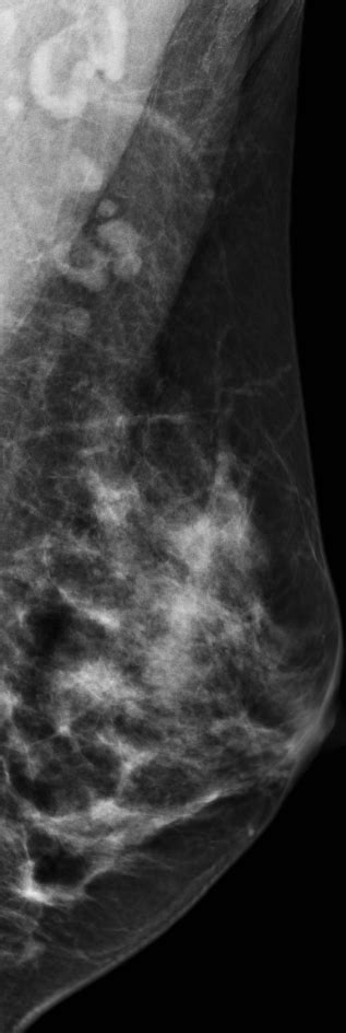 Normal Axillary Lymph Nodes Mammogram Image