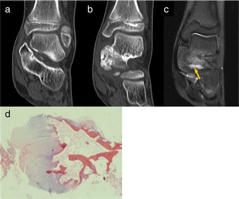 Imaging Findings Of Various Talus Bone Tumorsclinicoradiologic