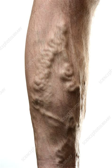 Varicose Veins Stock Image C0181029 Science Photo Library