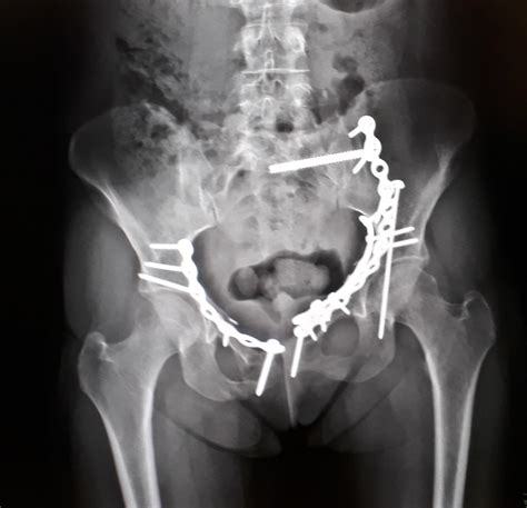 Thought You Guys Might Like To See My Pelvis X Ray Xrays