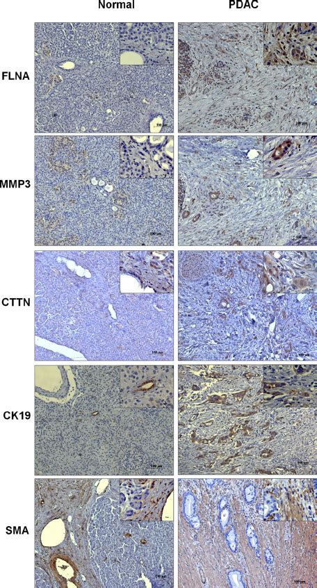 Immunohistochemical Analysis Of Normal And Pdac Tissues Tissue