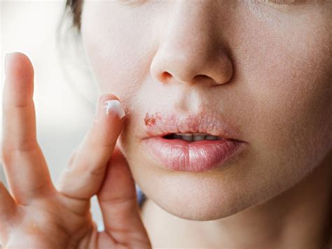 How To Treat Cold Sores With Topical Cbd Innocan Pharma