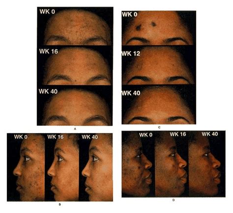 Topical Tretinoin Retinoic Acid Therapy For Hyperpigmented Lesions